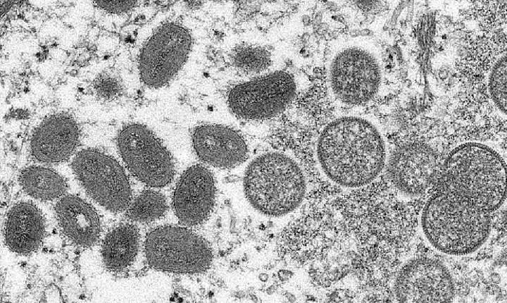 Brasil monitora casos suspeitos de varíola dos macacos, doença ‘despercebida’, diz OMS
