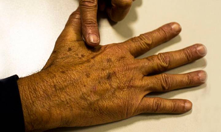 Paraná tem a segunda maior incidência de câncer de pele do Brasil, alerta dermatologista