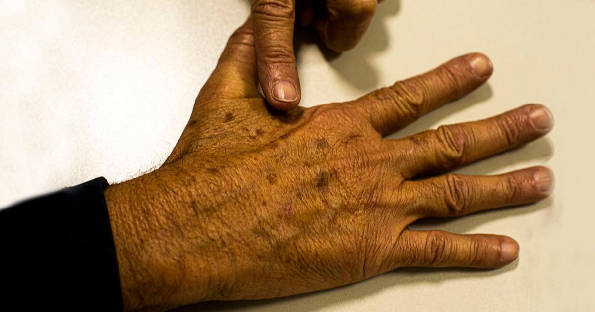 Paraná tem a segunda maior incidência de câncer de pele do Brasil, alerta dermatologista